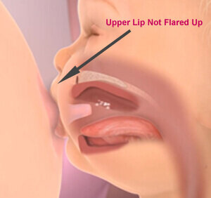 upper+lip+not+flared+info