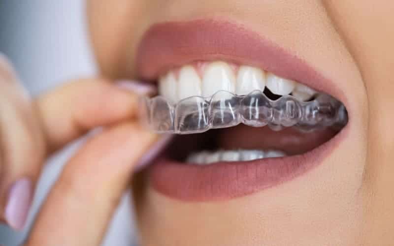 SureSmile® Clear Aligners - Jupiter Kids Dentistry
