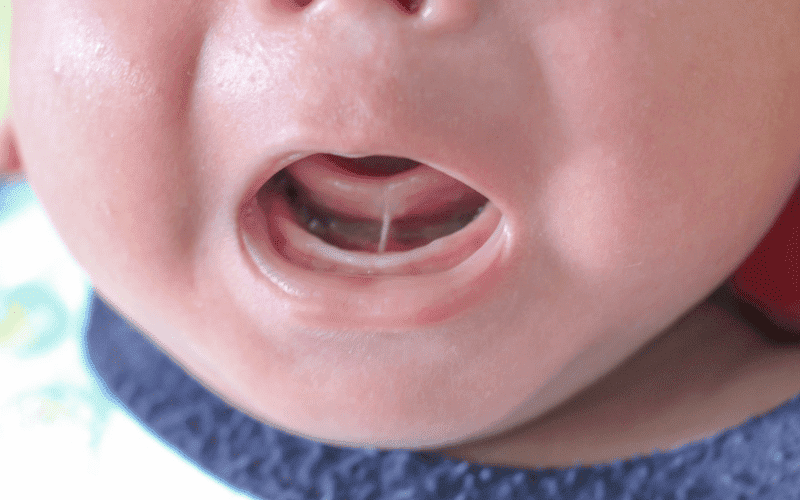 Frenectomy Recovery - Jupiter Kids Dentistry