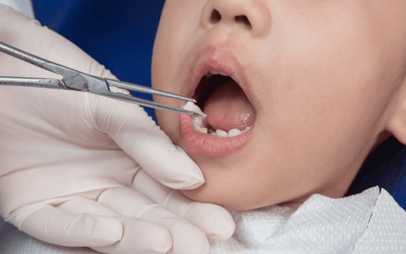 Tooth Extraction - Jupiter Kids Dentistry