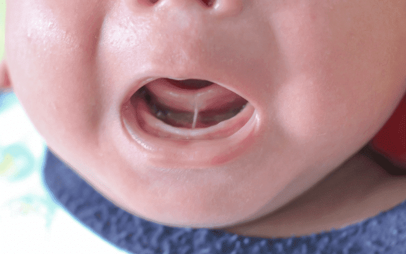 child’s recovery after frenectomy
