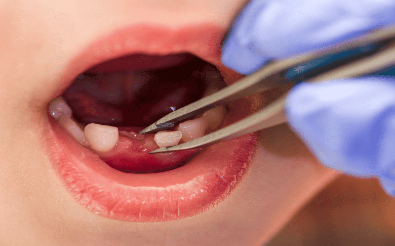 managing pain after children's tooth extractions