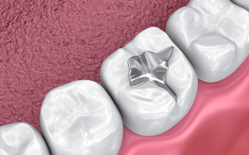 can tooth-colored fillings stain kids' teeth