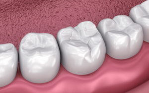how dental sealants can prevent cavities in children
