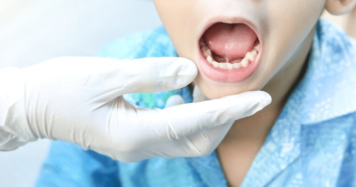 What is a Frenectomy and Why Might Your Child Need One