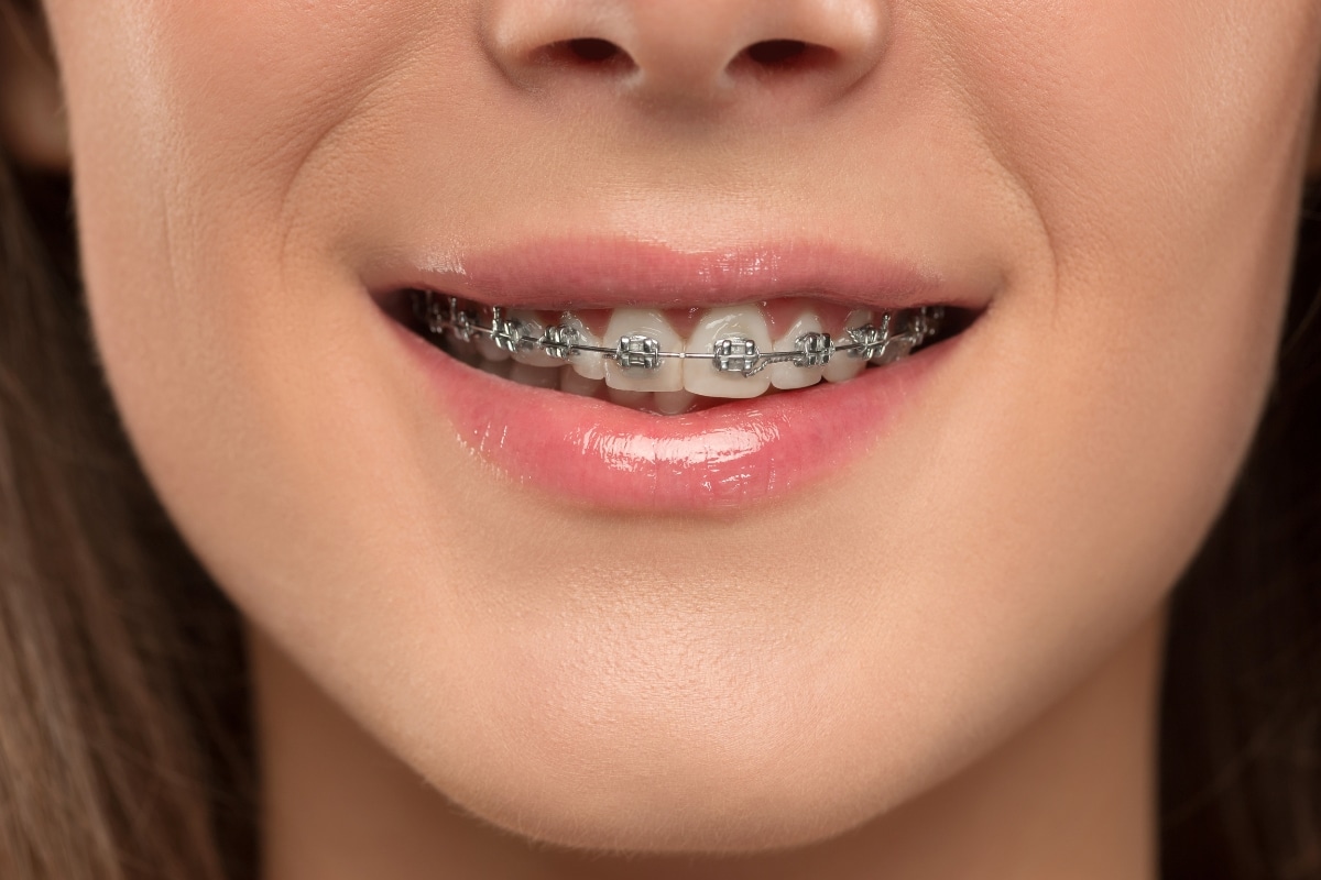 overbite, underbite & crossbite in teen orthodontics